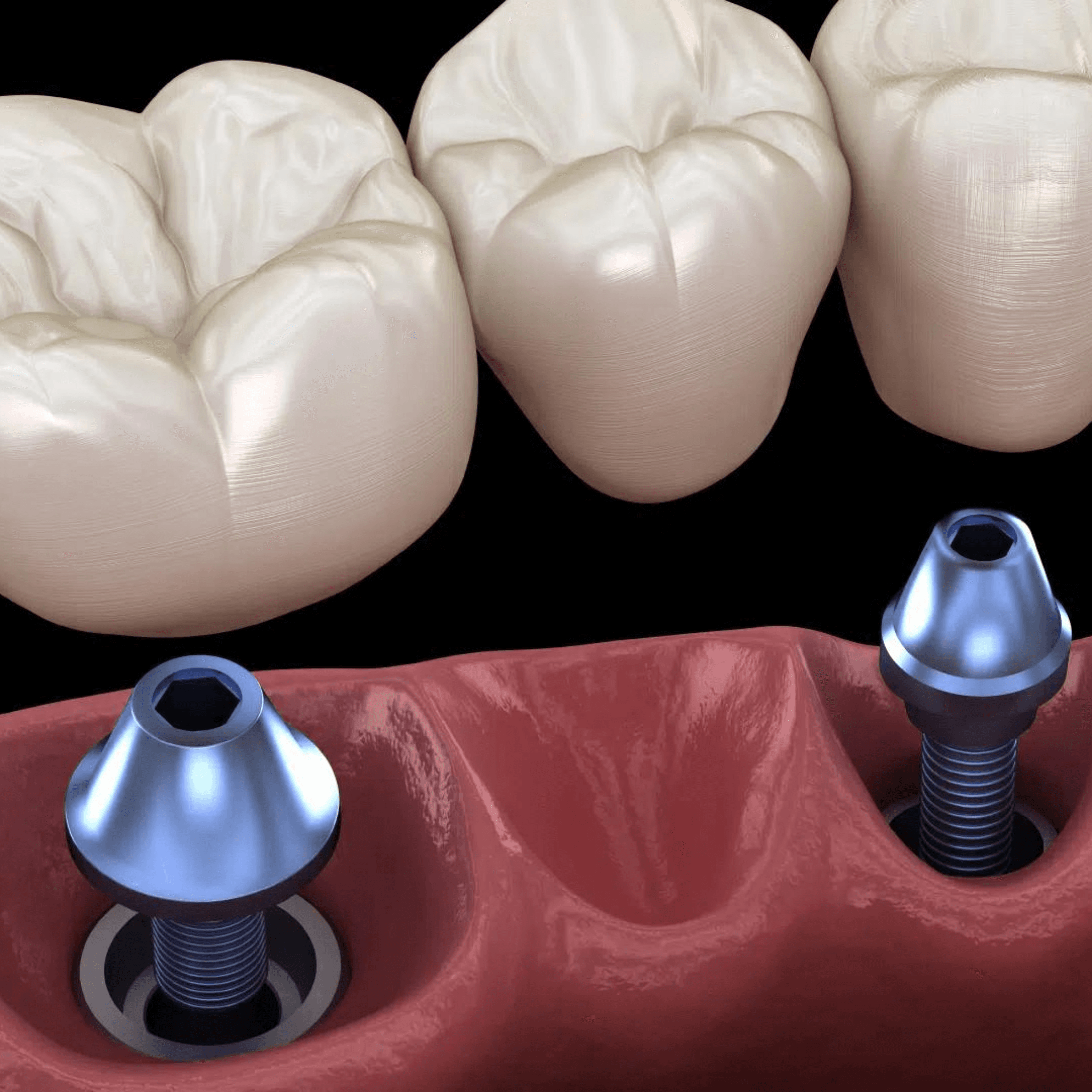 Treatment visualization for 3. Basal Implants