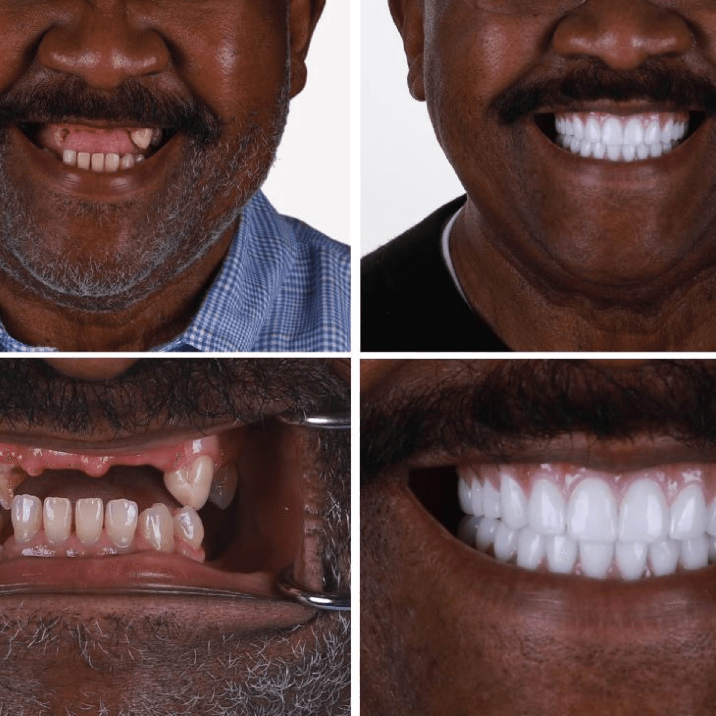 Treatment visualization for 2. Full Mouth Implants