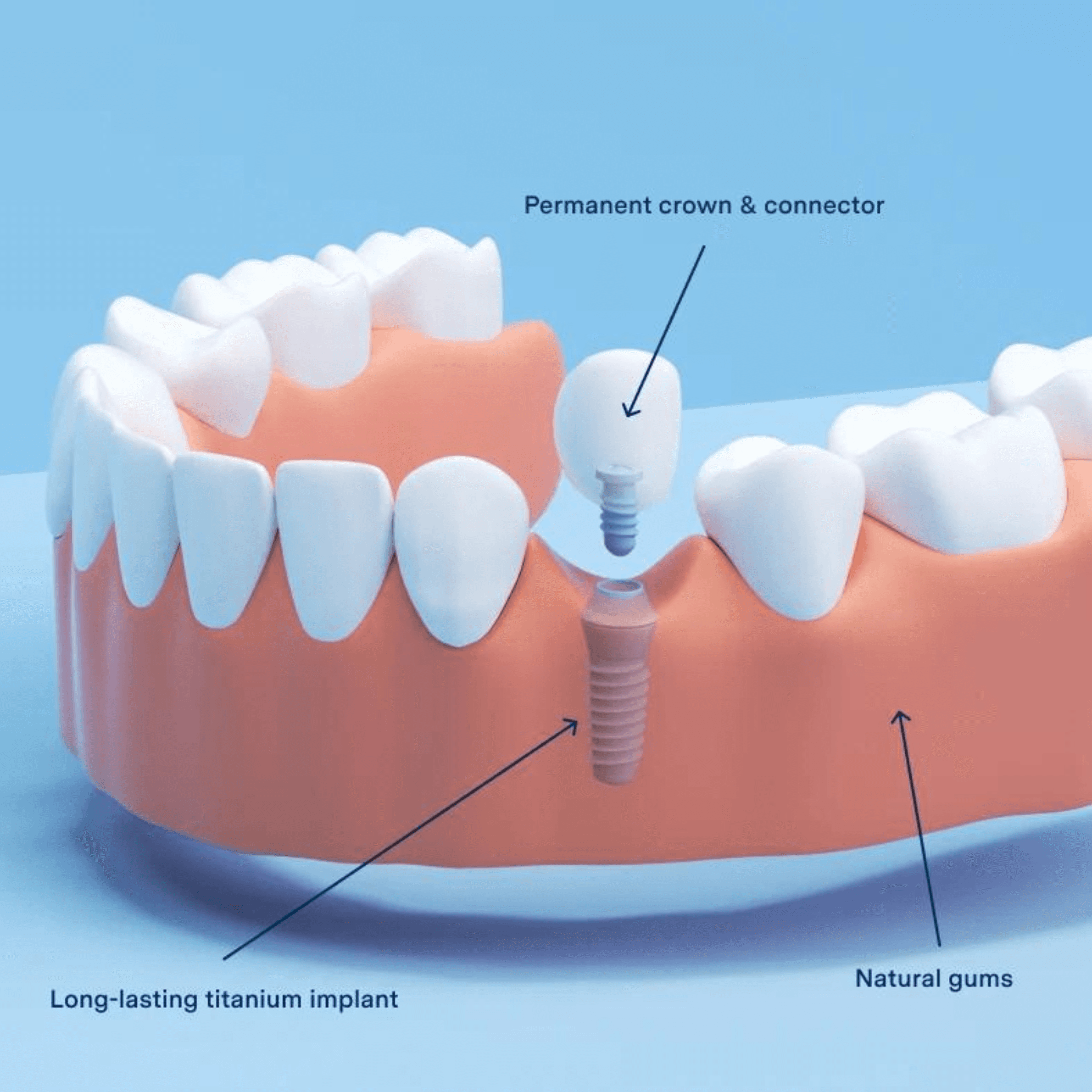 Treatment visualization for 1. Single Tooth Implant