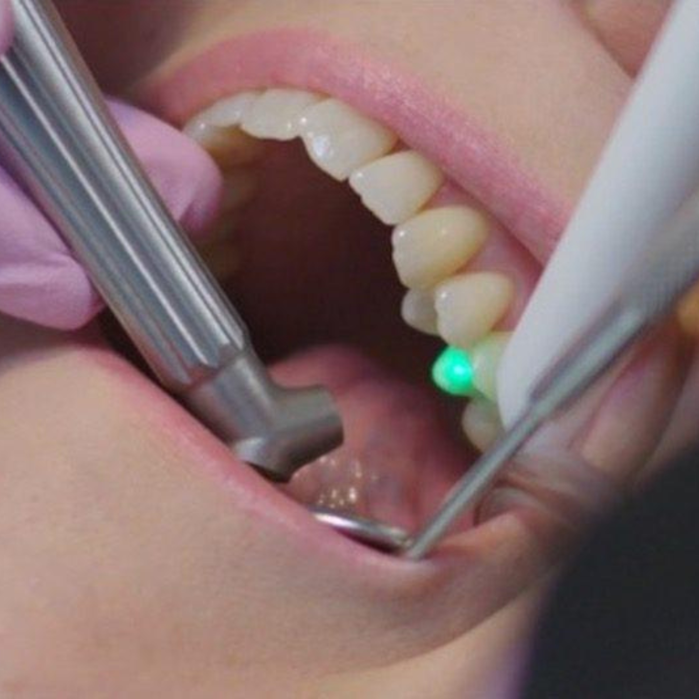 Treatment visualization for 2. Laser Root Canal Treatment