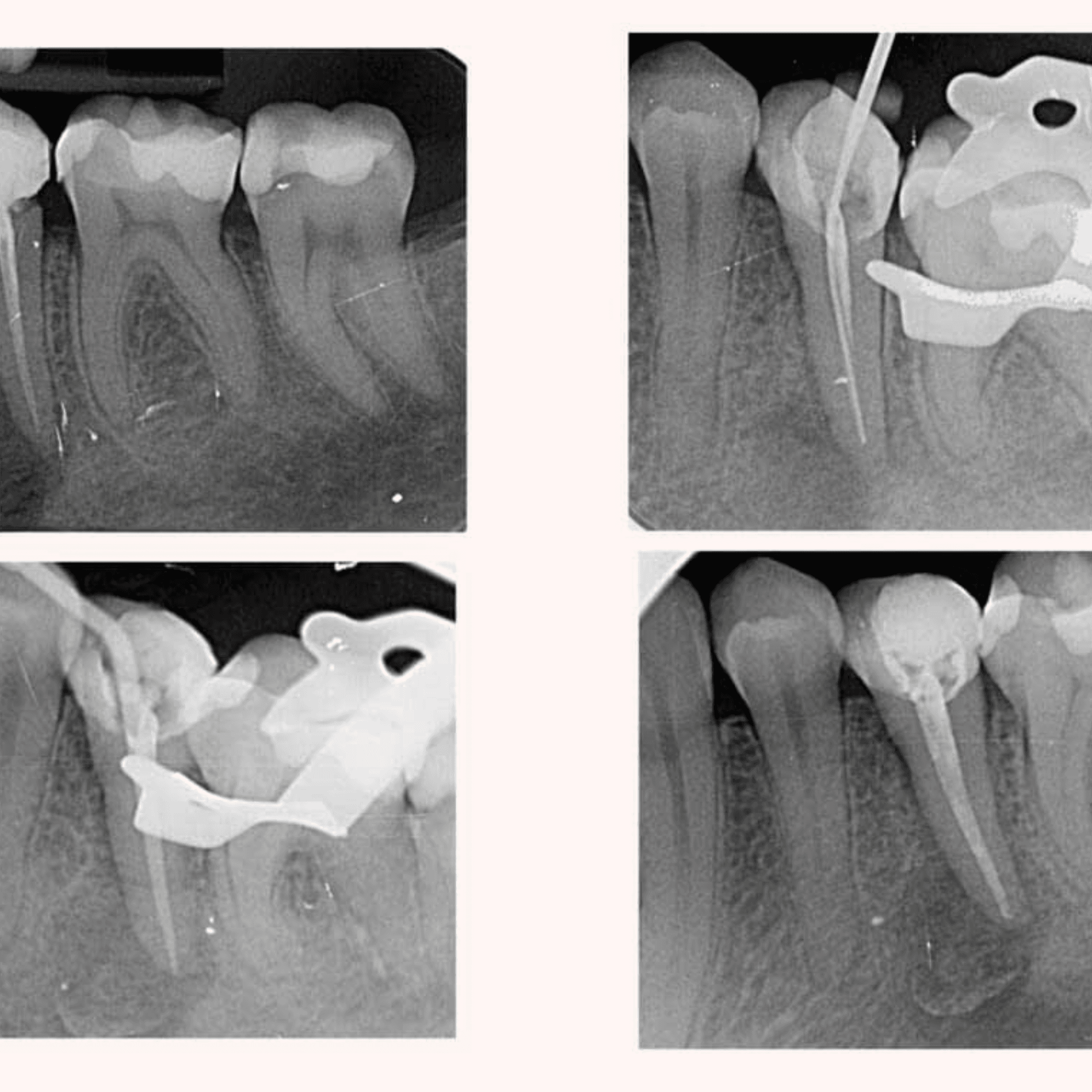 Treatment visualization for 4. Re-Root Canal Treatment (Re-RCT)