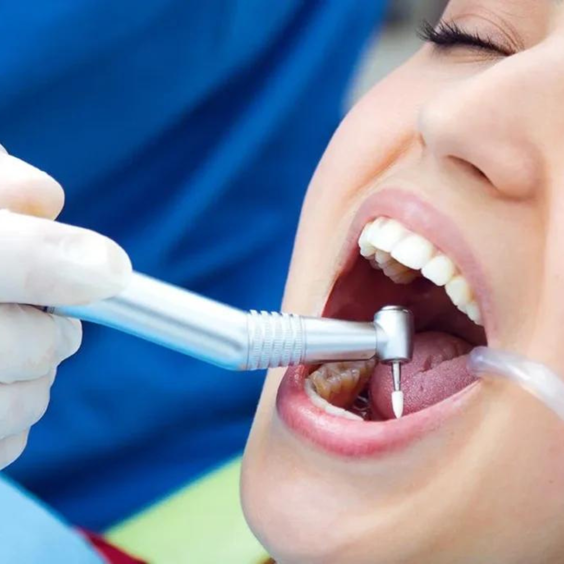 Treatment visualization for 3. Single Sitting Root Canal Treatment
