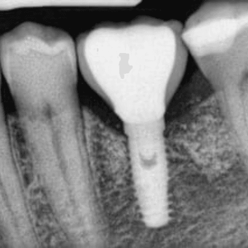 Detailed tooth implant model illustrating osseointegration foundation