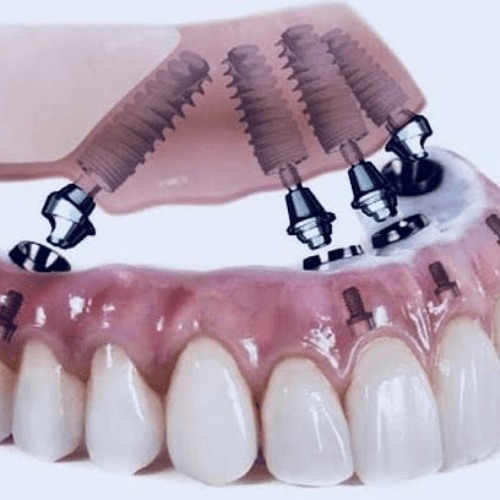 Confident smile after dental implant restoration