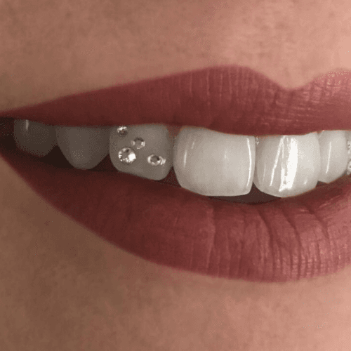 Close-up of a elegant tooth gem crystal applied professionally