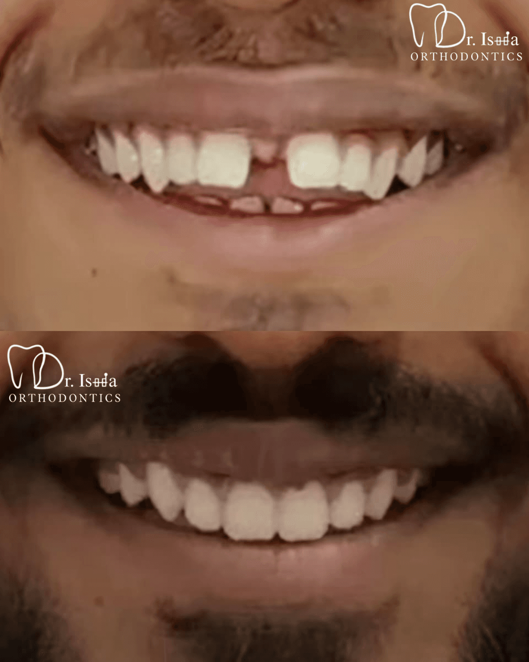 Smile transformation 5