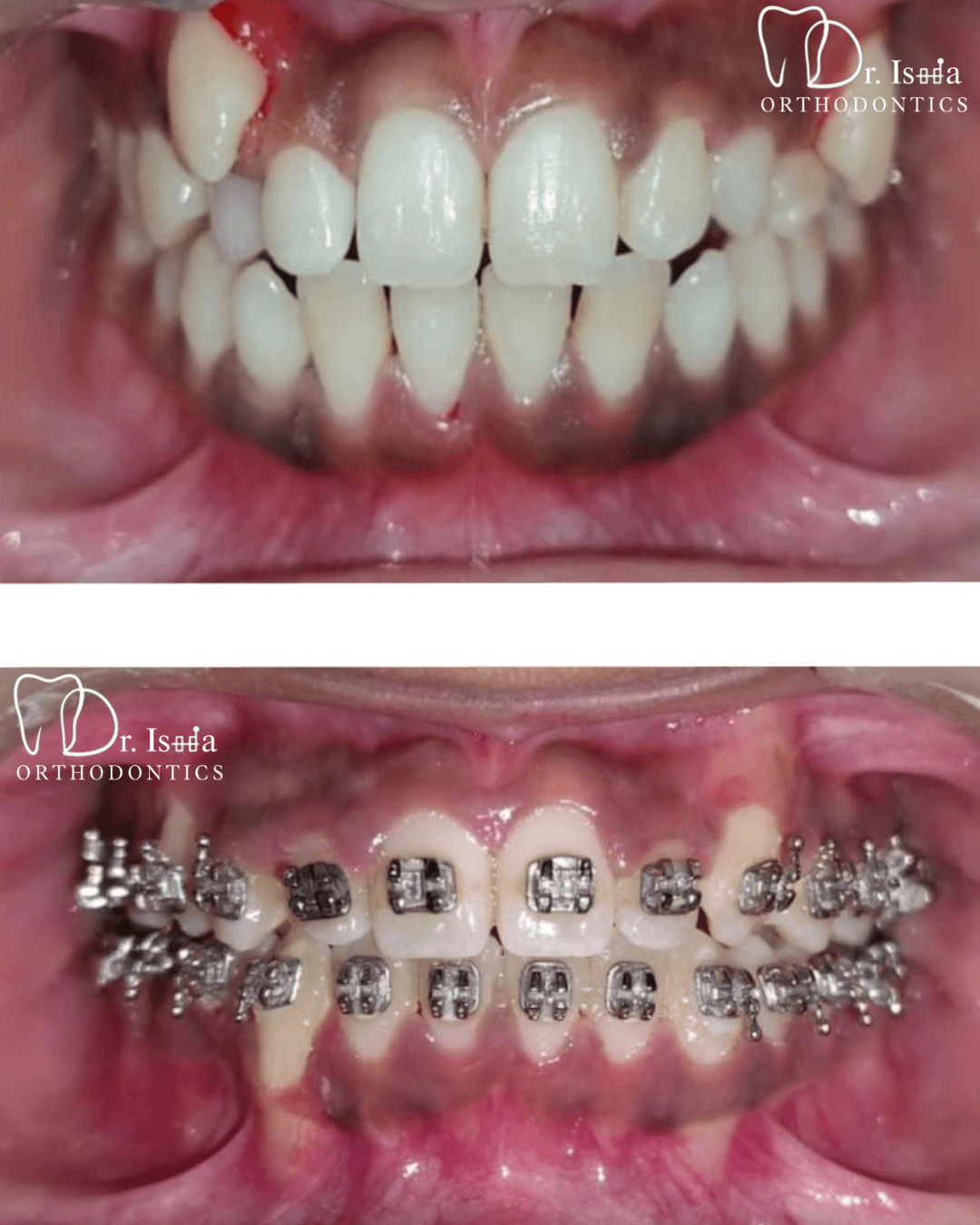 Smile transformation 6