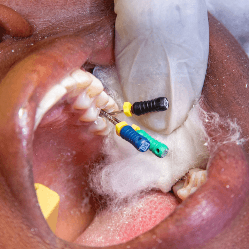Endodontic laser instrument cleaning tooth roots