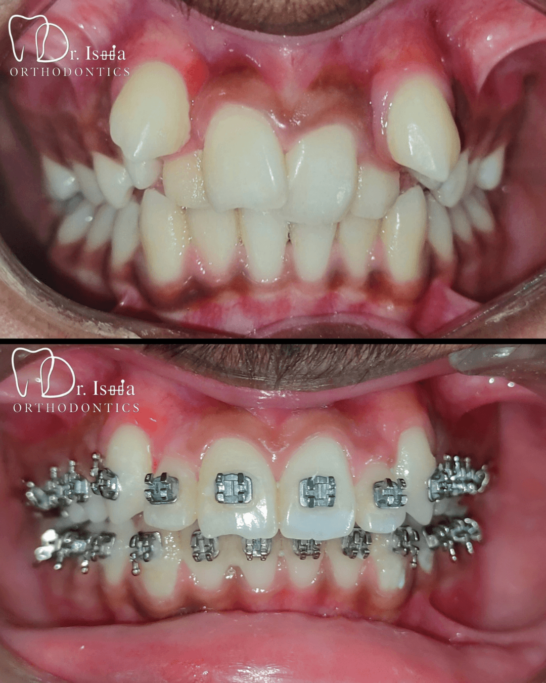Cosmetic Veneers and Smile Design Transformation