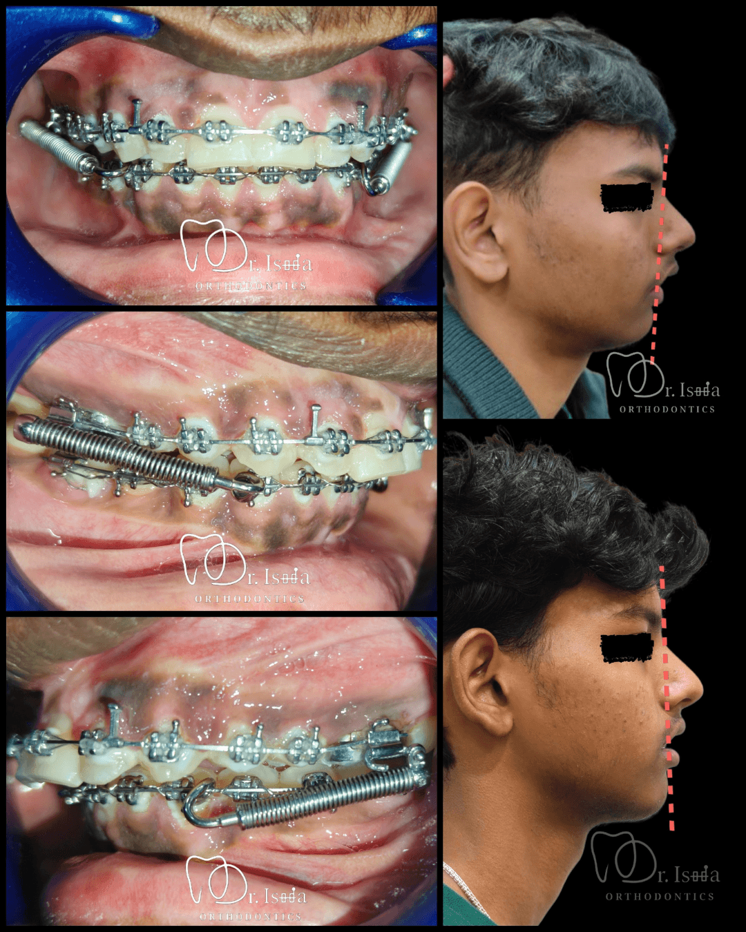 Orthodontic Precision Alignment Before and After