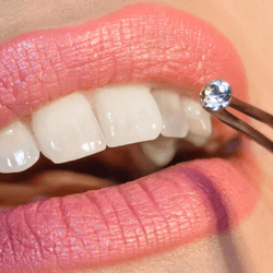 Dental Jewellery treatment