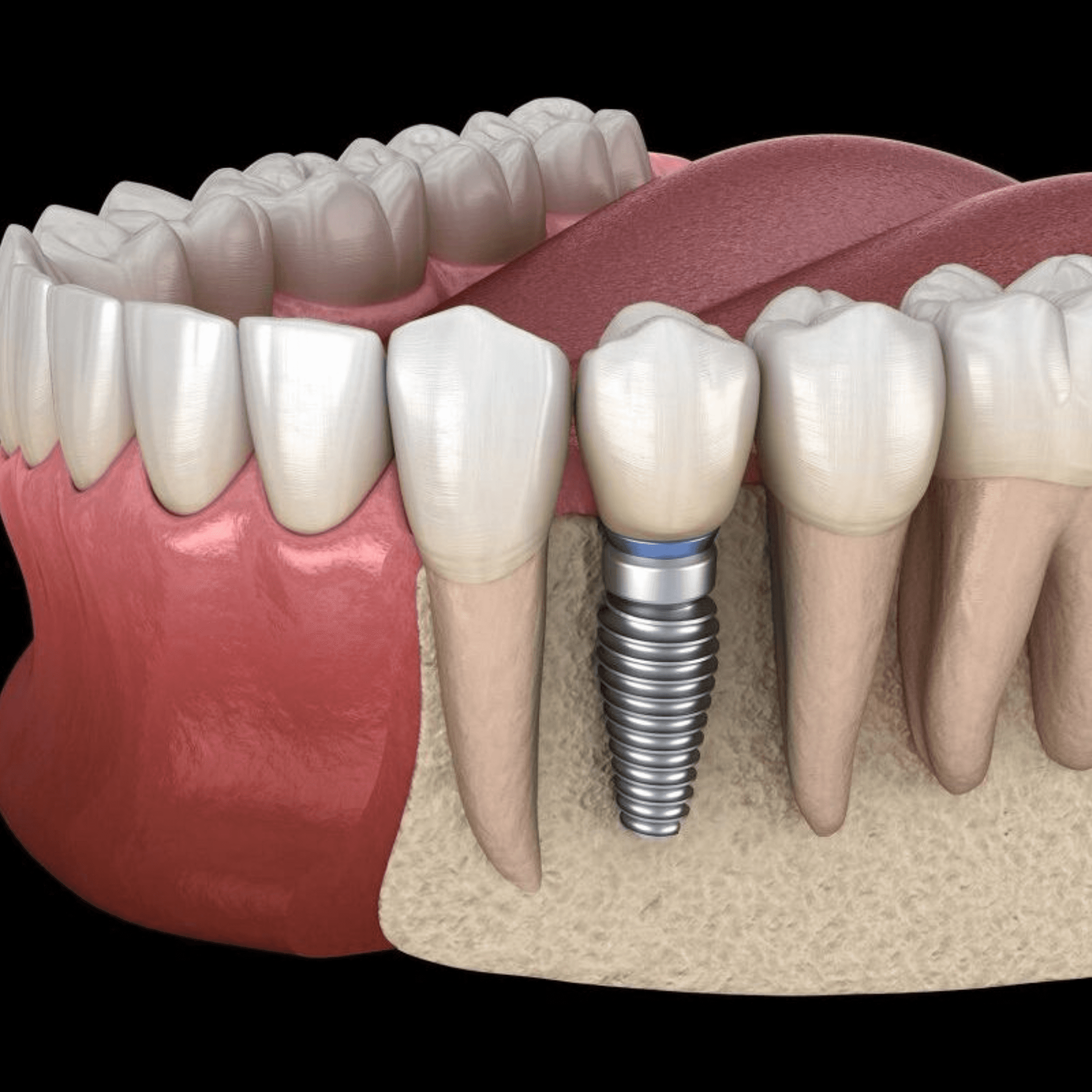 A high-quality dental implant mockup illustrating how a replacement tooth is securely anchored into the jawbone
