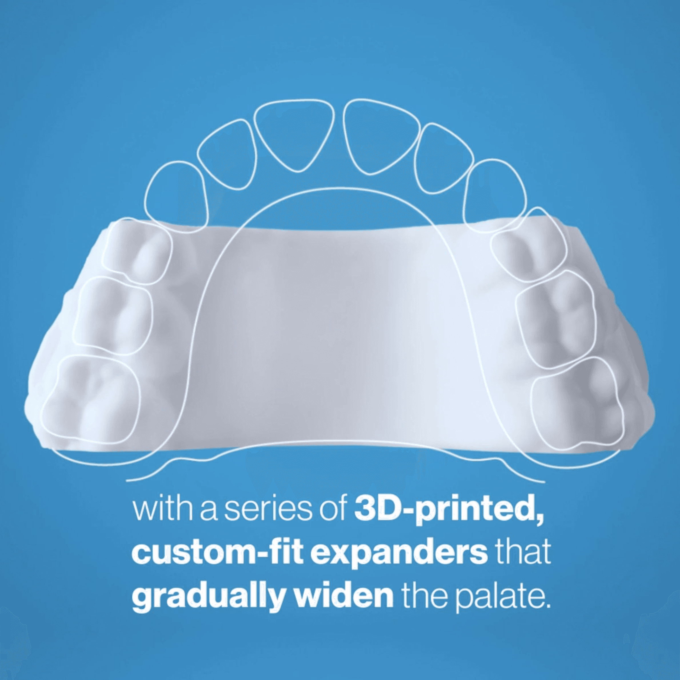 Treatment visualization for 3. Invisalign Palatal Expander