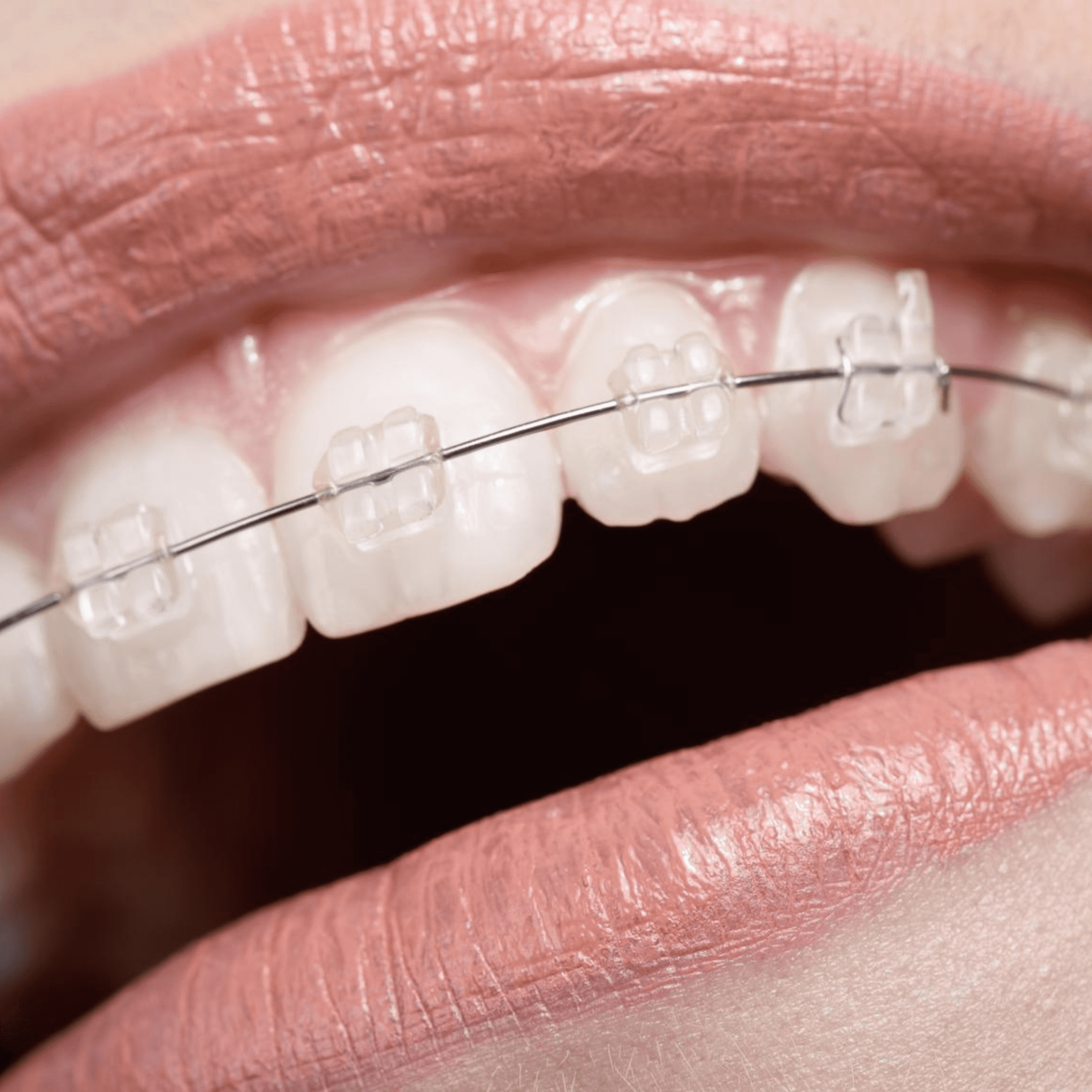 Treatment visualization for 2. Ceramic Braces