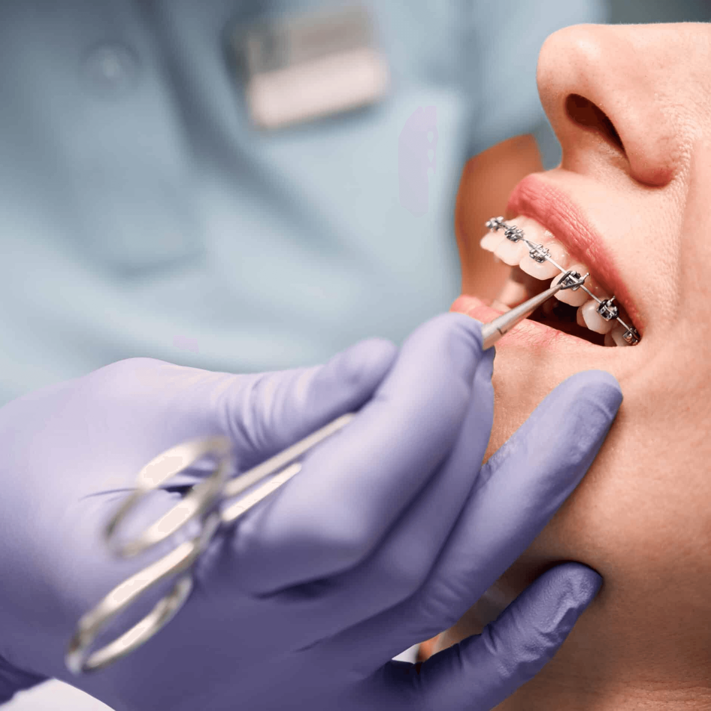 Treatment visualization for 1. Metal Braces