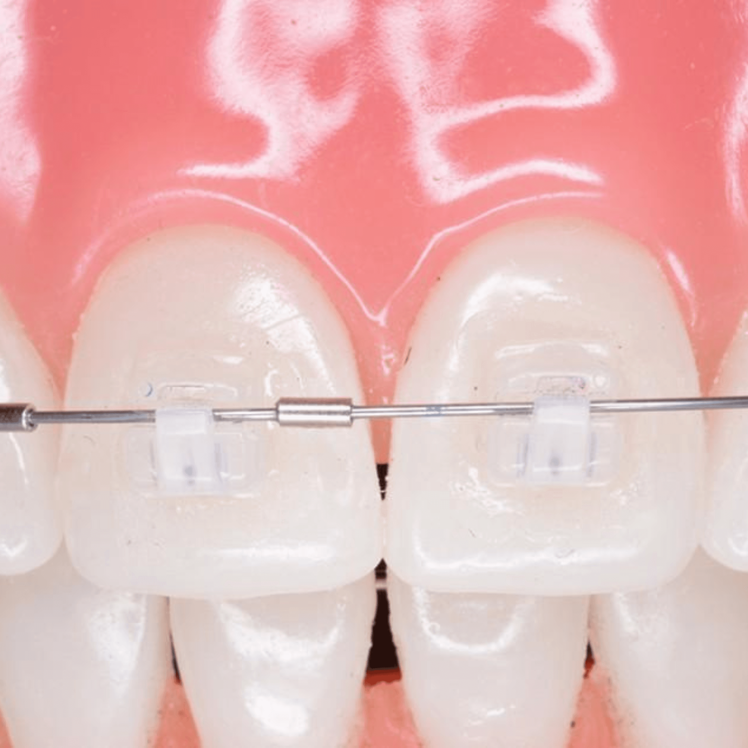 Treatment visualization for 4. Self-Ligating Ceramic Braces