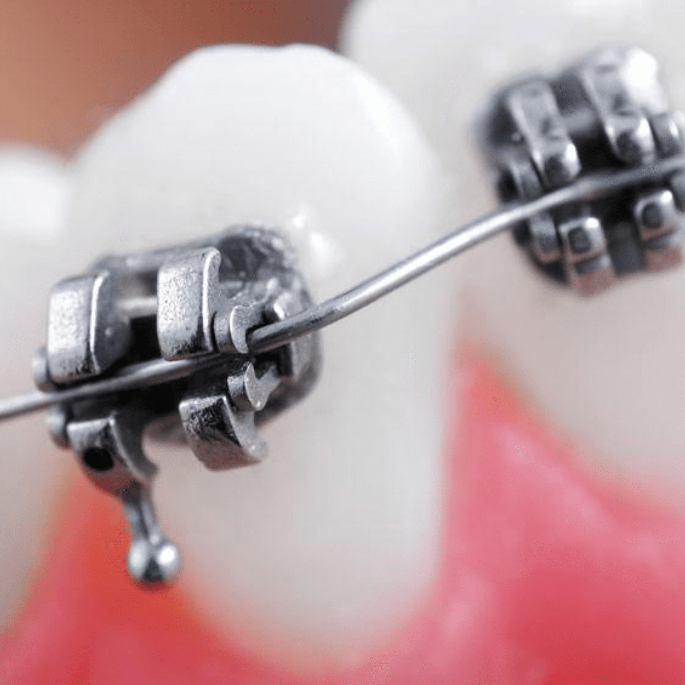 Treatment visualization for 3. Self-Ligating Metal Braces