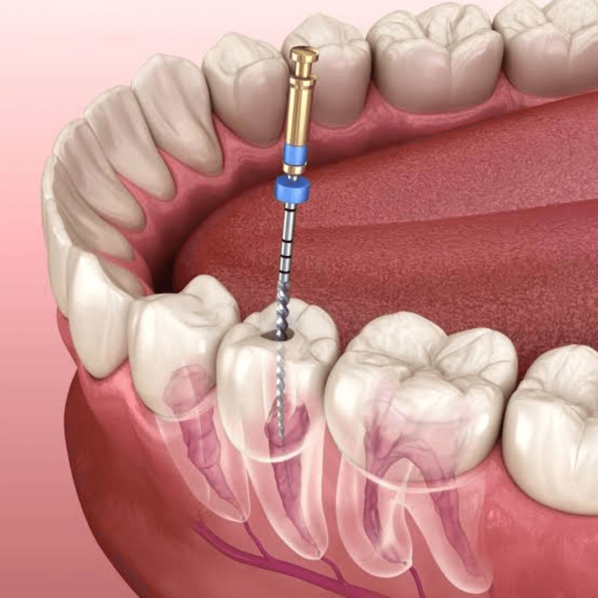 A specialized dental professional performing a painless, state-of-the-art root canal procedure to save a natural tooth