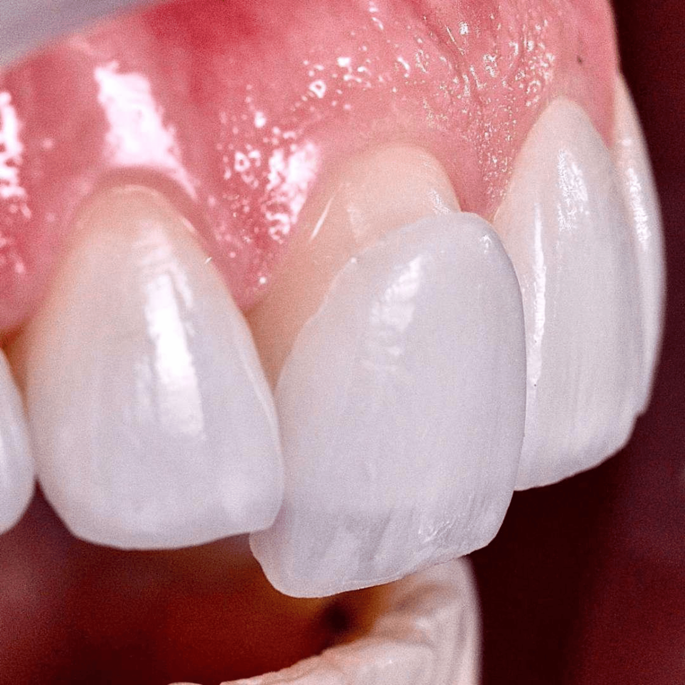 Beautiful, natural ceramic veneers outcome visual
