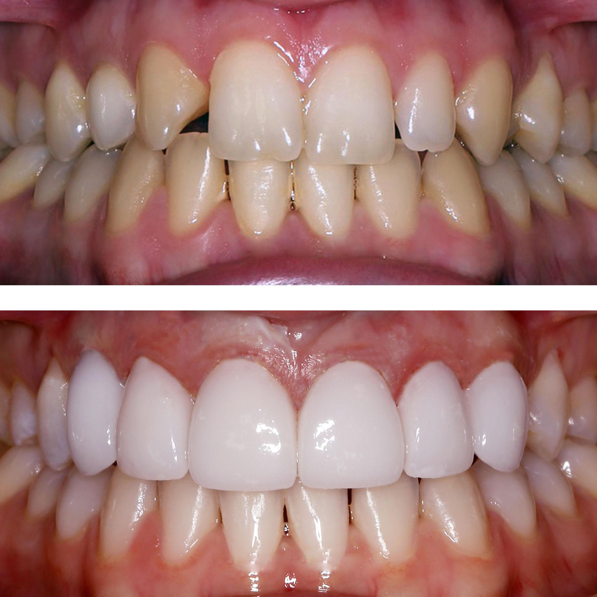 Treatment visualization for 2. Composite Veneers