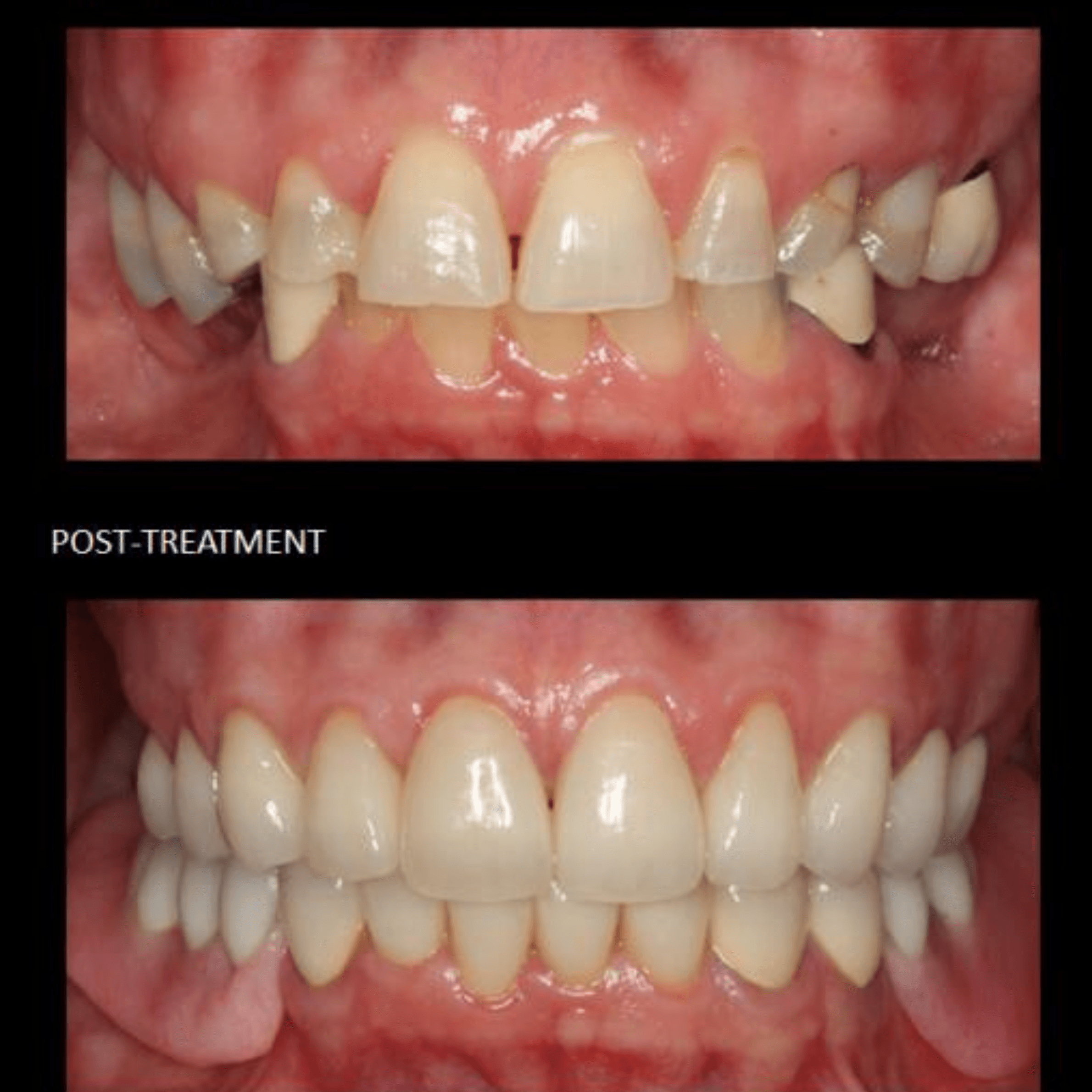 Treatment visualization for 1. Full Mouth Rehabilitation