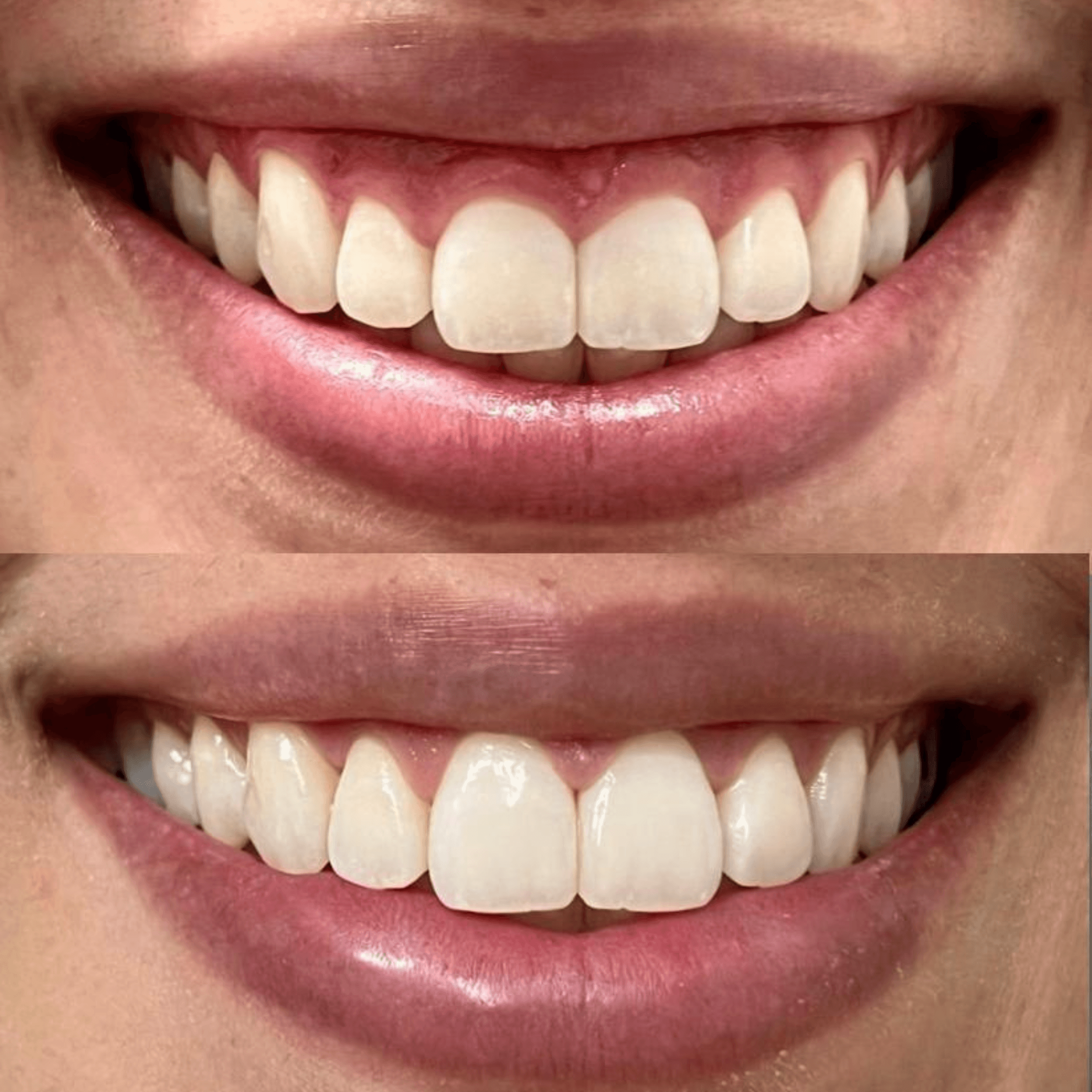 Treatment visualization for 6. Gum Contouring