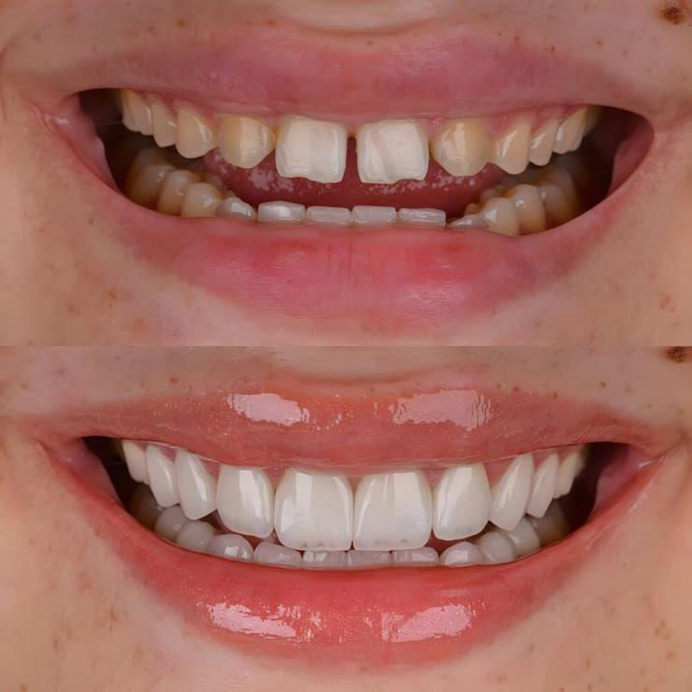 Treatment visualization for 5. Laminates