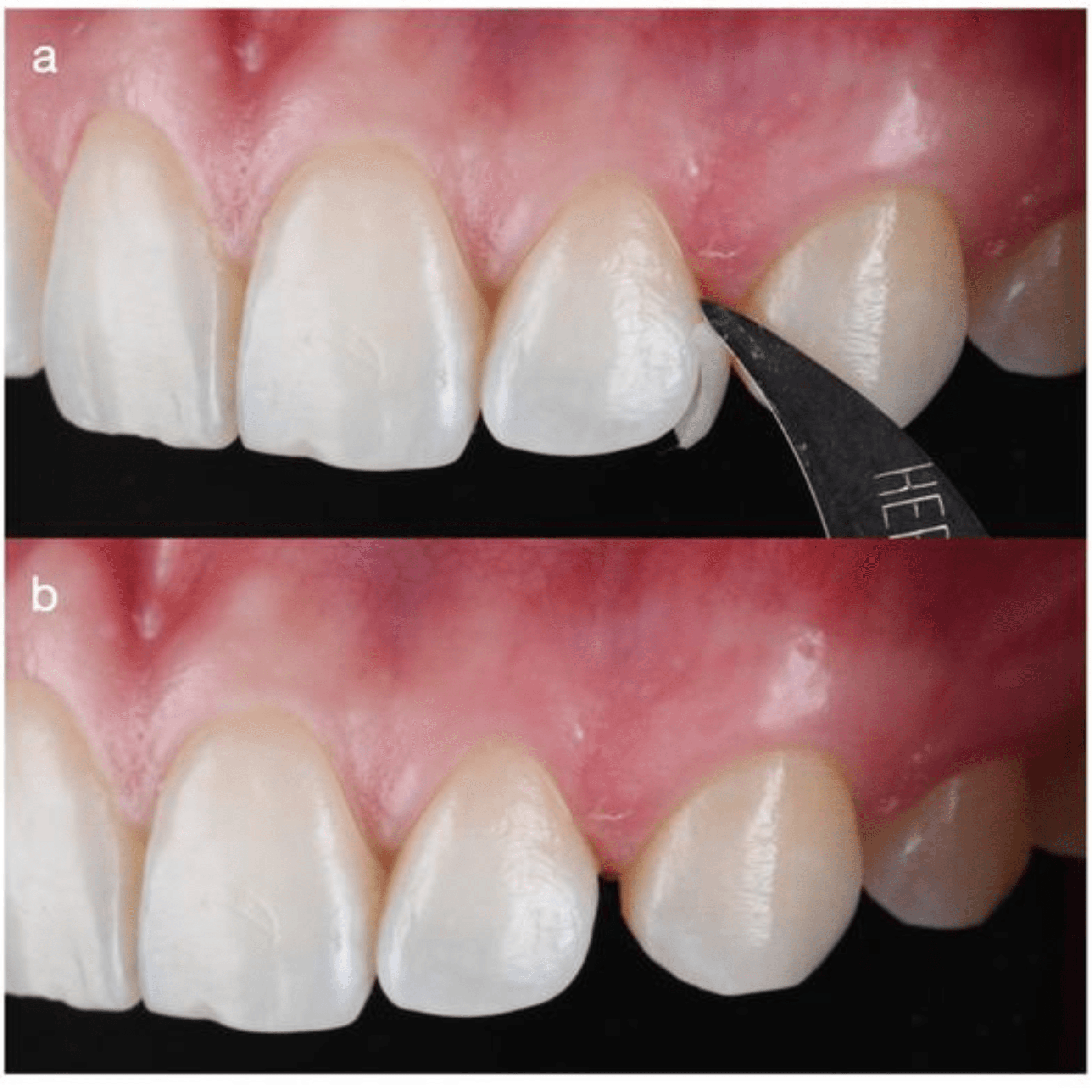 Treatment visualization for 4. Partial Veneers