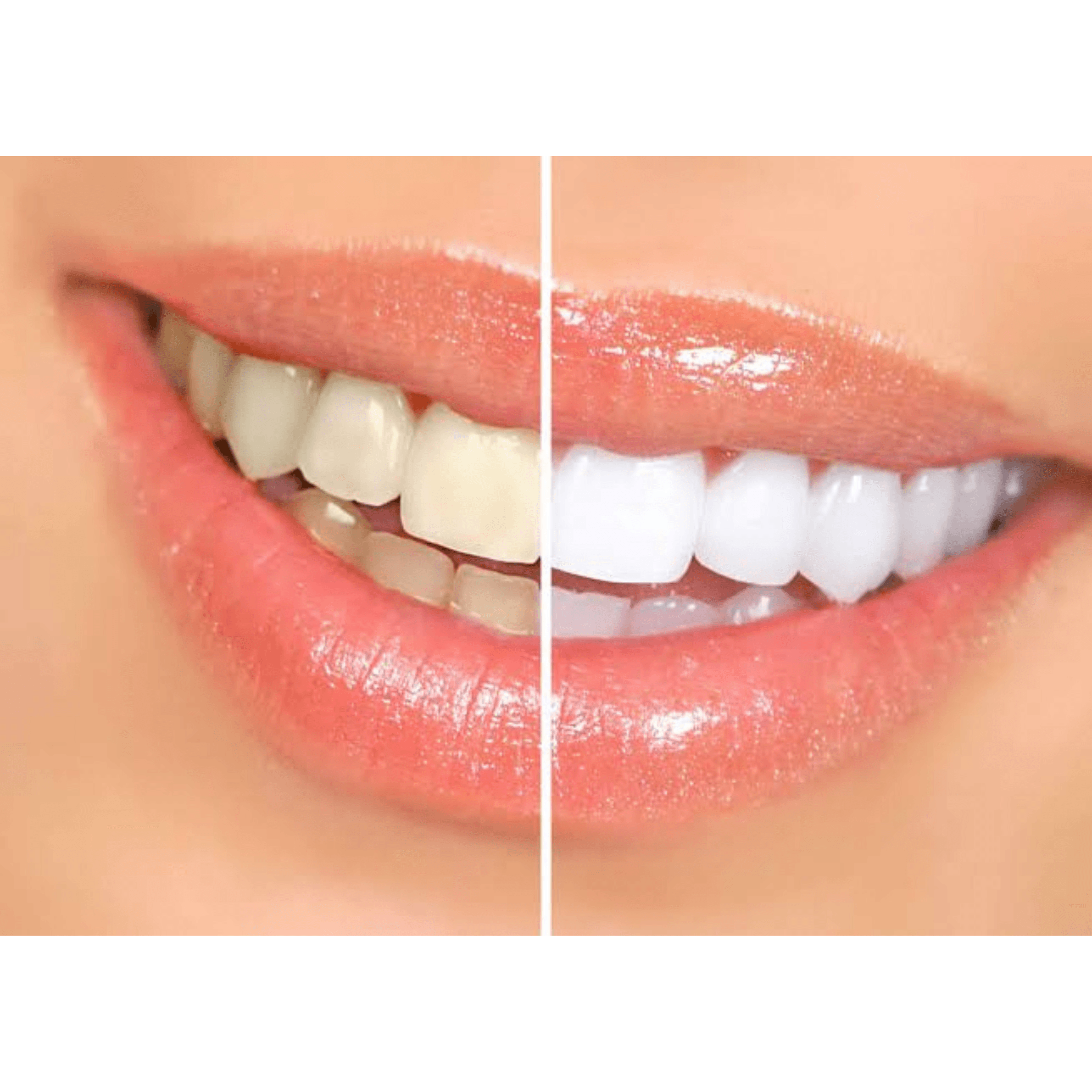 A patient receiving professional teeth whitening treatment with an advanced light-curing system for a brighter smile