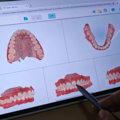 A dentist displaying preview of 3D aligner digital treatment plan