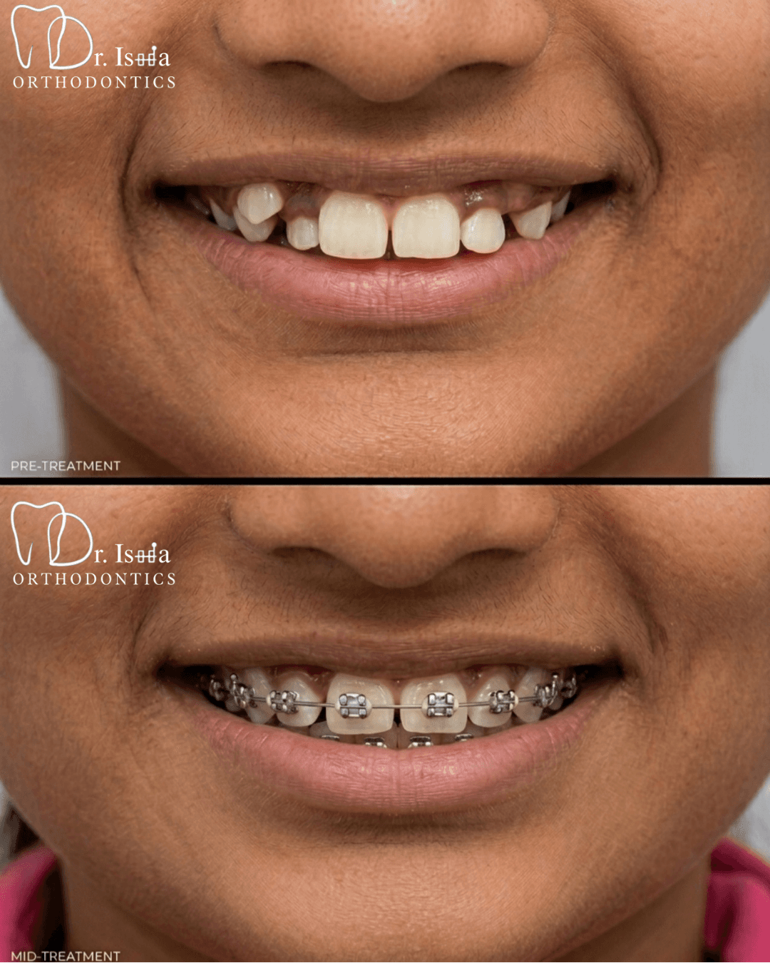 Smile transformation 4