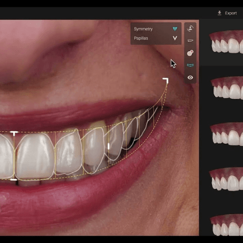 Stylized preview showing cosmetic smile design transformation