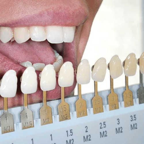 Teeth shade guide comparison showing whitening enhancement stages