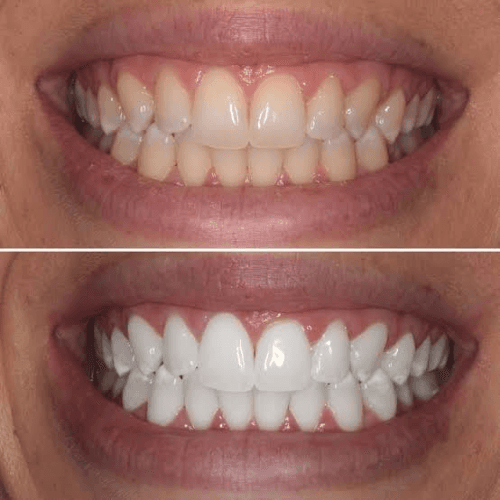 Treatment visualization for 1. In-Office Teeth Whitening
