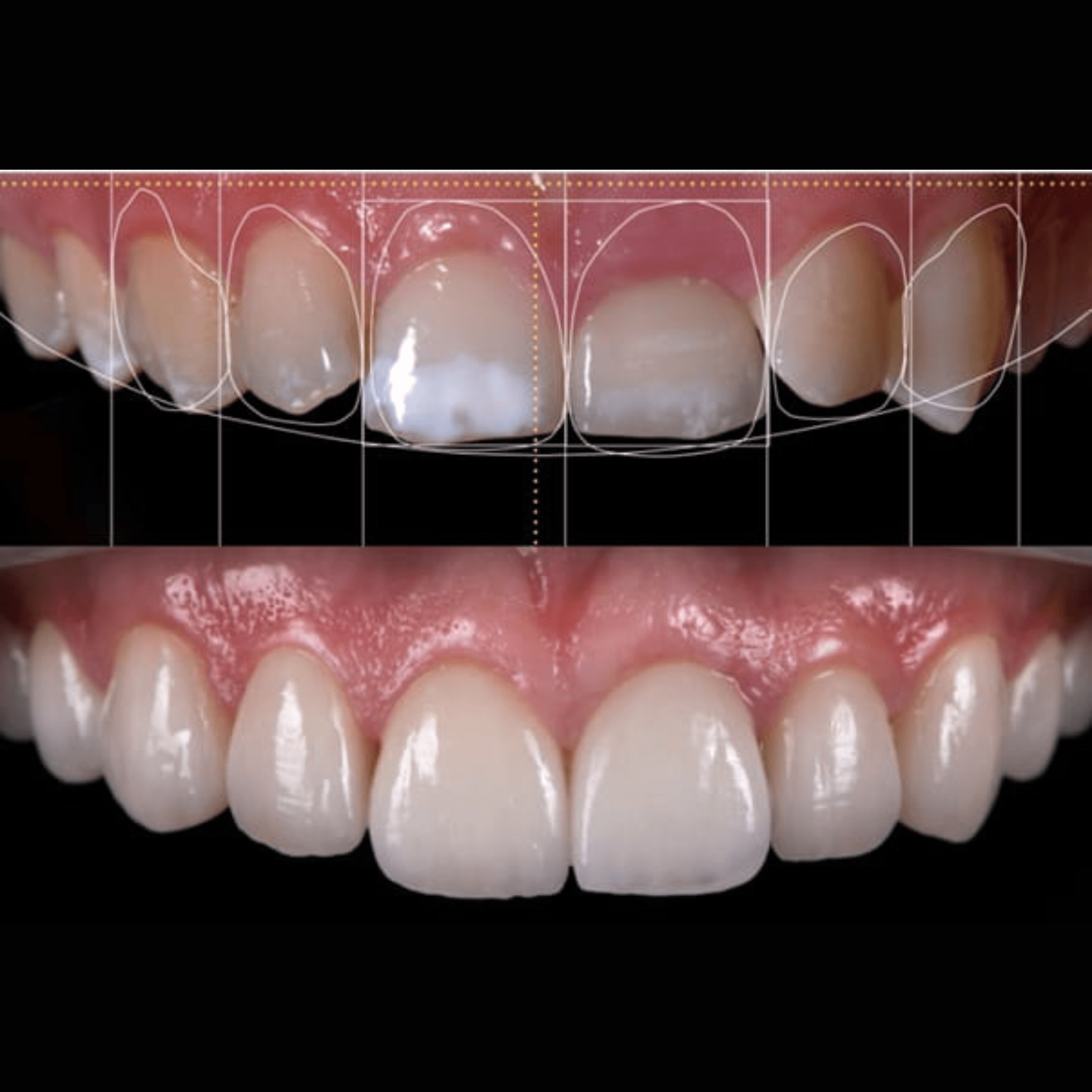 Beautiful, natural ceramic veneers outcome visual